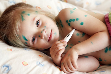 Girl suffers chickenpox