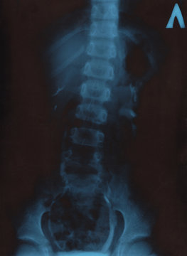 X-ray picture of human torax