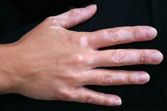 A hand with vitiligo skin condition