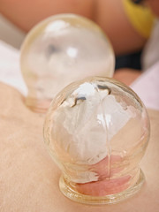 Traditional Chinese Cupping