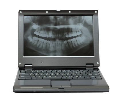 small laptop with dental picture of jaw