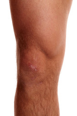 Linkes Knie vom Mann