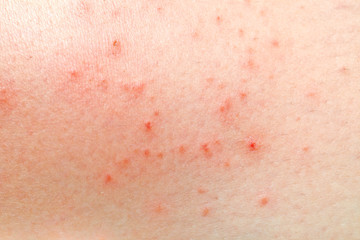 wounds on woman skin