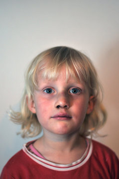 Kind mit blauen Flecken 2