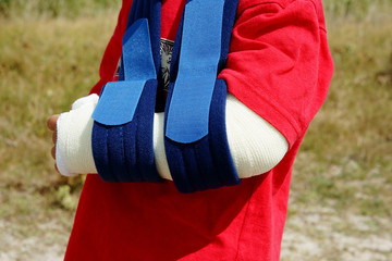 fracture du bras