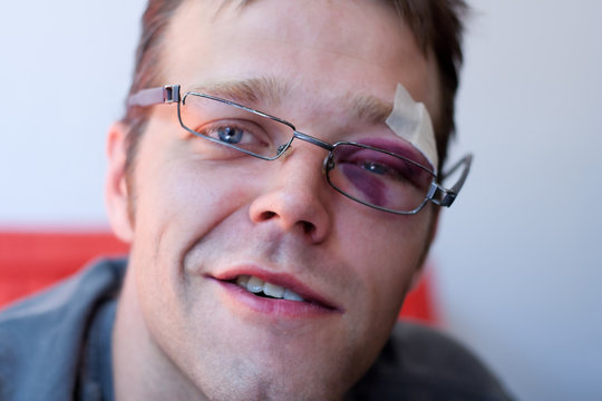 Jugendlicher/Mann mit blauem Auge/Verletzung