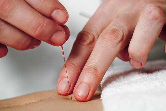 Working hands of acupuncture