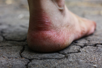 Human foot with cracks and fissures