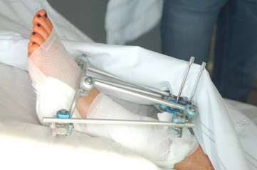broken leg