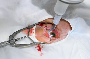 Eye surgery using liquid nitrogen