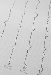 EKG