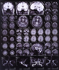 X-ray image of the brain