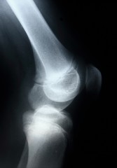X-ray picture showing knee joints