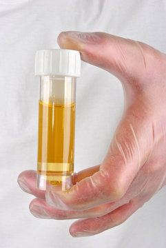 eine Urinprobe in einer Probenflasche