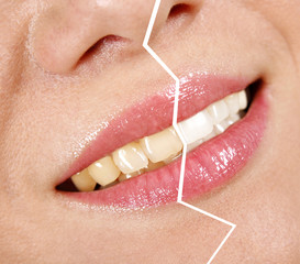 Whitening