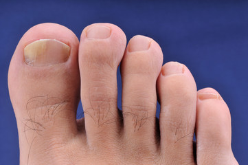 Close up image of foot toe nail suffering from fungus infection