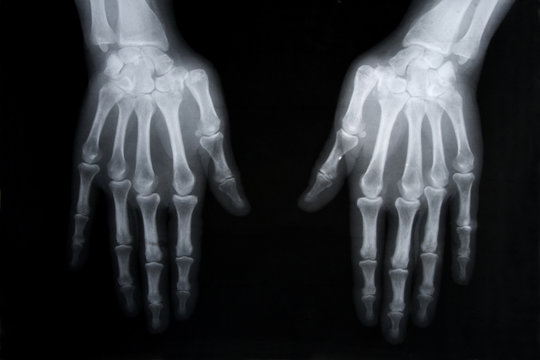 x-ray picture of human hands