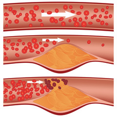 Cholesterol plaque in artery (atherosclerosis) illustration