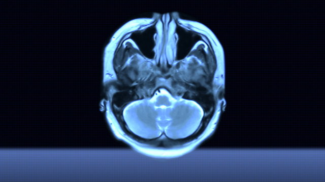 MRI brain scan
