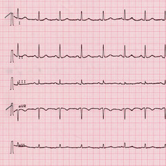 Electrocardiography of heart beat