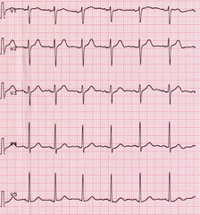Electrocardiography of heart beat