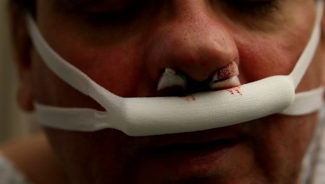 Nase nach Nasenoperation