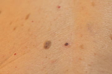 Wart 2
