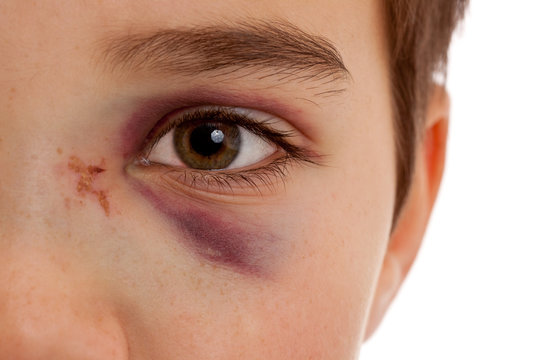 Gebrochene  Nase und verletztes blaues Auge nach Unfall