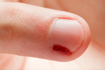 Blood wound finger nail