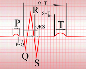 Intervals, compex of  ECG
