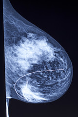 Mammogram - Needle Localization