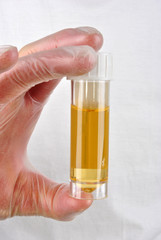 eine Urinprobe in einer Probenflasche