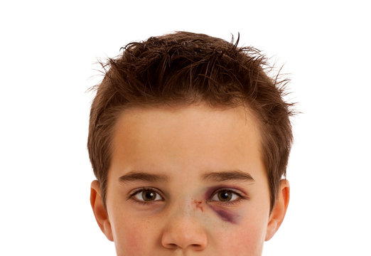 Verletzter Junge mit blauem Auge