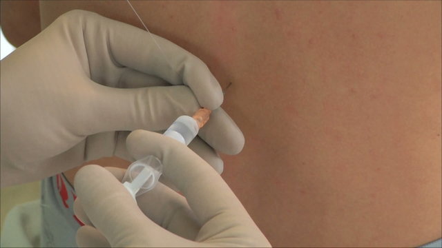 наркоз перед операцией 2