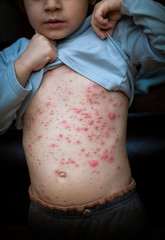 varicelle bouton contagieux maladie enfant contagion démangeais