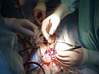 Heart operation