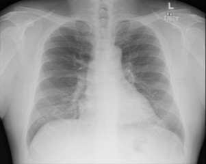 Chest X-ray