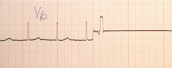 Electrocardiogram ECG,EKG