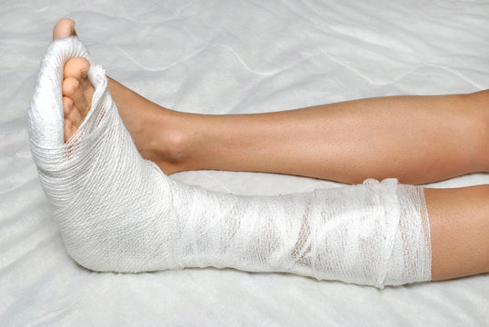 Broken ankle hi-res stock photography and images - Alamy