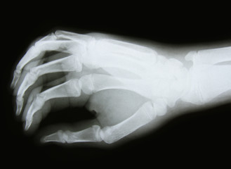 x-ray image of the bones of arm