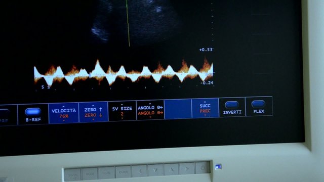 Monitor - ecografia