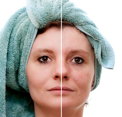 Woman with spotty skin with deep pores  and healed soft skin