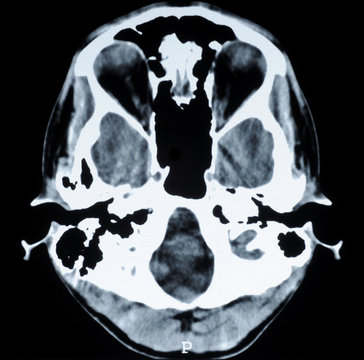 CT photo of human brain