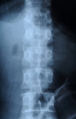 radiograph of human backbone