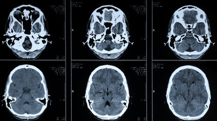 CT photography of human brain