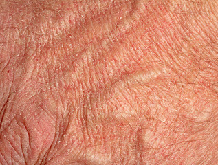 Fototapeta premium Dry skin on hand