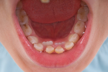 New teeth of a child coming to replace the old ones.