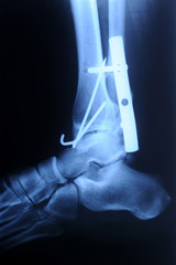 radiograph of human fracture ankle