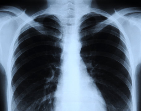 radiograph of human chest