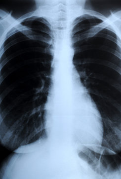 radiograph of human chest